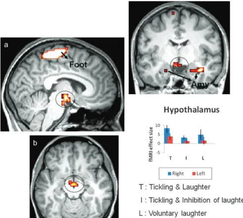 Figure 4. Conjunction analysis and effect size. Increased significance of hypothalamic activation in response to T versus I and versus L (a: sagittal paramedian; b: axial; c: frontal;