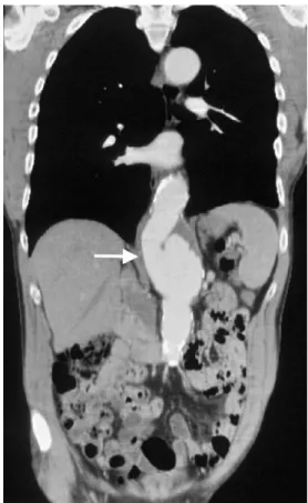 Fig. 1. A 6 cm type IV aortic aneurysm (arrow).
