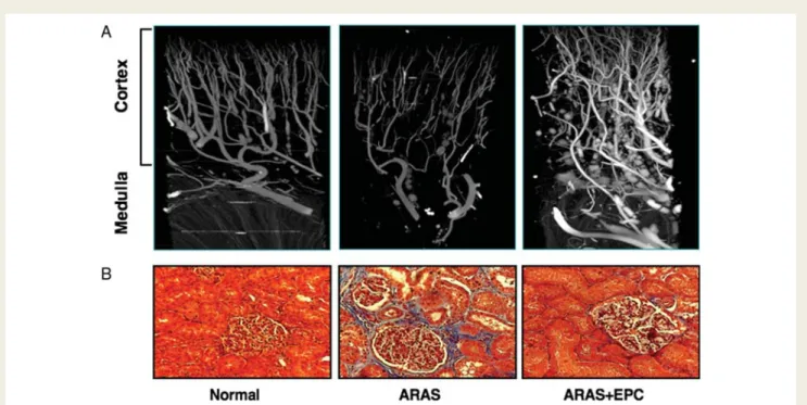 Figure 4 Representative micro-CT images of the swine kidney microcirculation (A) and fibrosis (B, trichrome staining, ×20) in normal, ather- ather-osclerotic RAS (ARAS), and ARAS pigs treated with intrarenal endothelial progenitor cells (EPC) 4 weeks earli
