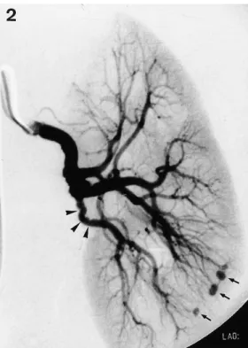 Fig. 2. Post-operative angiogram demonstrating good arterial filling cal evidence of glomerulonephritis