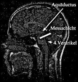 Fig 1: sagittales Spin-Echo Bild zur Planung der Messschicht.
