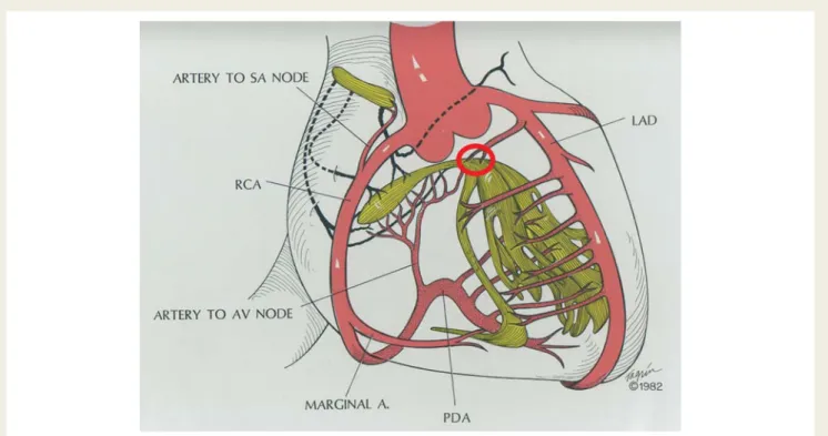 Figure 1 End – systolic frame from a left ventriculogram in left anterior oblique, cranially angulated projection in a patient with hypertrophic obstructive cardiomyopathy