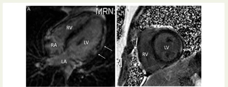Figure 9: Focal myocarditis in a 4-year-old child who presented with chest pain and elevated cardiac enzymes