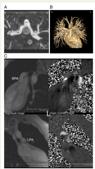 Figure 2: In a patient with transposition of the great arteries, who underwent the arterial switch operation with Lecomte manoeuvre, contrast-enhanced MR angiography demonstrates well the  rela-tionship between the pulmonary arteries and the surrounding st
