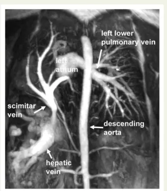 Figure 3: Maximum intensity projection reconstruction of CE-MRA images in the coronal plane in a patient with Scimitar  syn-drome