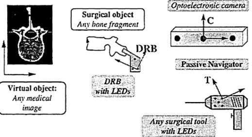 Figure J: Scheme of subcutaneous spinal siabilisation Our research focus is towards minimally invasive spine stabilisation that offers potential benefits, such äs: