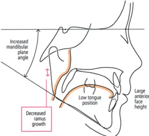 Figure 2      Tracing of a child after adenotonsillectomy. Because of  normalization of breathing and tongue position, the mandibular plane  angle has been found to decrease and mandibular growth accelerated with  no changes in anterior face height (adapte