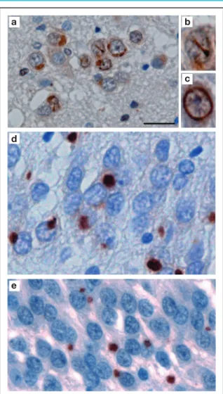 Figure 4. Pathological spectrum of FTLD-UPS.