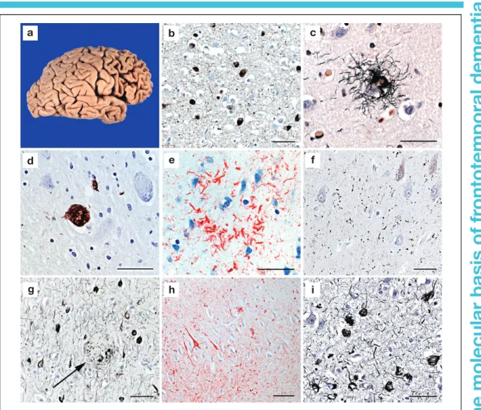 Figure 2. Pathological features in FTLD-tau. (a) Severe atrophy of the frontal and temporal lobes and (b) Pick bodies in the temporal cortex of a patient with Pick disease
