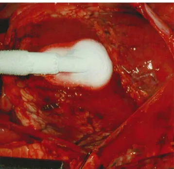 Fig. 1. Control of major bleeding (up to 60 cm jets) by the means of a cryoprobe driven with liquid nitrogen after left ventricular laceration