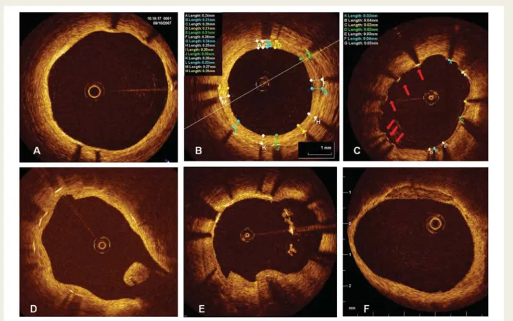 Figure 1 shows the profile of the OCT sub-study. Twenty-eight patients allocated to BESs and 32 patients allocated to SESs
