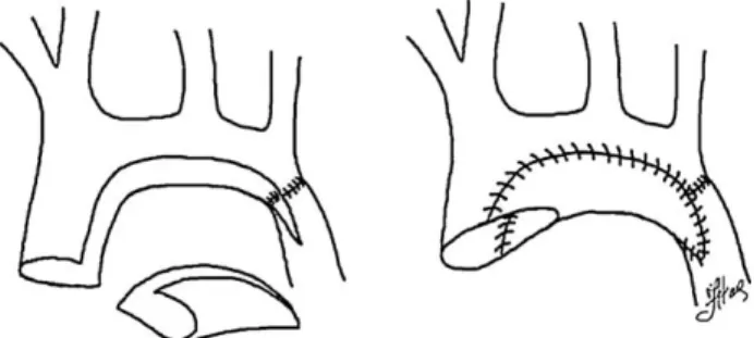 Fig. 1. Surgical technique for hypoplastic arch repair: after excision of ductal tissue the proximal descending aorta is attached to the junction of the distal ascending aorta and proximal transverse arch in an end-to-side fashion.