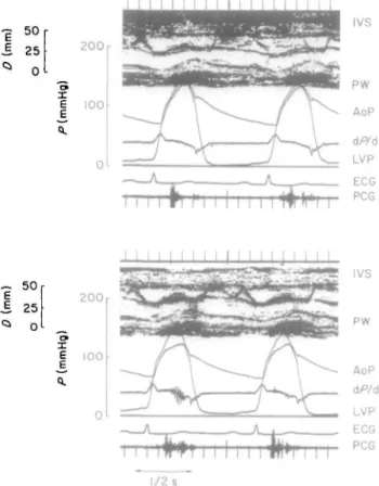 Figure 2 Left ventricular simultaneous echo-pressure measurements in a patient with hypertrophic  cardio-myopathy before (upper panel) and after (lower panel) intravenous administration of 8 mg verapamil