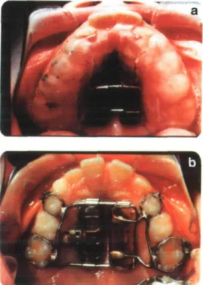 Figure 1 (A) The bonded MED. (B) The banded MED.