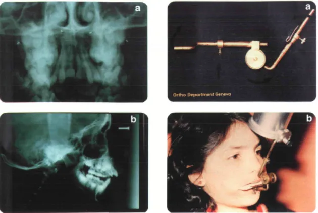 Figure 7 (A) Standardization device used for the occlusal radiographs. (B) In situ.