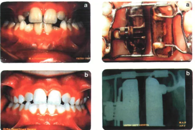 Figure 11 (A) A banded type of MED in place. (B) Opening of the mid-palatal suture is evident in the second week of expansion.