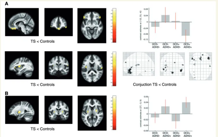 Figure 1 Statistical parametric maps of significant grey matter volume change in the Tourette syndrome cohort superimposed for presentation purposes at P 50.001, uncorrected, on T1-weighted image