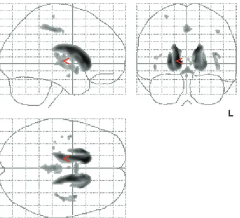 Figure 1. Results of voxel-based morphometric comparison between HD patients (n 5 44) and controls (n 5 22) (ANCOVA including individual cognitive performances)