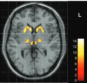 Figure 3. Overlay of significant voxel clusters onto structural 3-D MRI of an individual HD patient after inversed normalization, i.e