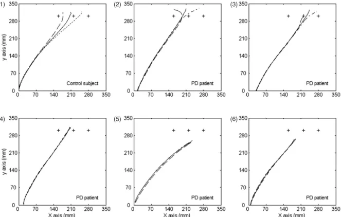 Fig. 9 Mean primary motor responses exhibited by a control subject (panel 1) and the five Parkinson’s disease (PD) patients (panels 2–6) for movements directed to the reference (T 4 , continuous line) and jumping targets (T 4–1 , dashed line; T 4–7 , dotte