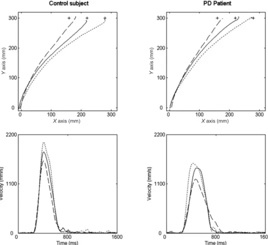 Fig. 3 Individual and path and corresponding velocity profiles exhibited by a control subject (left panels) and a Parkinson’s disease (PD) patient (right panels) for movements directed to the intermediate (T 4 , continuous line) and extreme (T 1 , dashed l