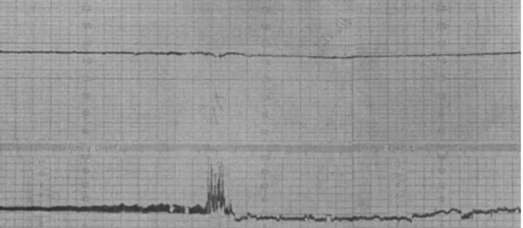 Fig 1 CTG trace recorded during anaesthesia. The upper line shows the FHR. This is constant at 150 beats min ±1 , but without variations in baseline frequency (silent pattern)