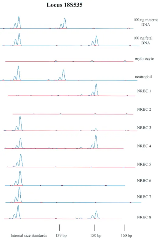 Figure 1. Electropherograms of locus 18S535 for maternal DNA, fetal DNA and 10 cell picks.