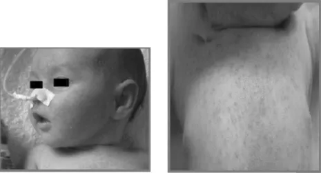 Fig. 1. Cutaneous lesions in a female newborn infant with autosomal recessive PHA1: neonatal miliaria crystallina (patient 1).