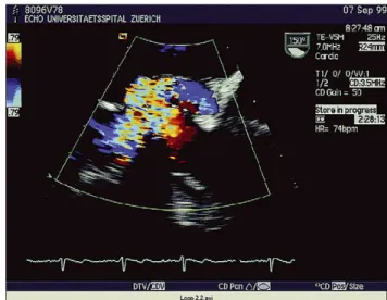 Fig. 1. TEE: CM 23, artificial aortic valve (Carbomedics w ); L, left atrium;
