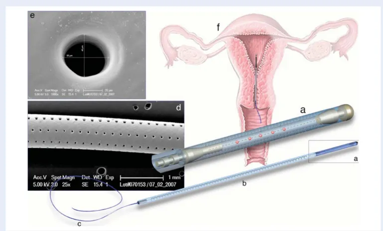 Figure 1 Diagram of the IUCS used in women undergoing ICSI: (a) microdrilled silicone segment containing the oocytes/embryos; (b) stabilization segment; (c) extraction segment; (d) scanning electron microscopy of the drilled silicone segment (magniﬁcation 
