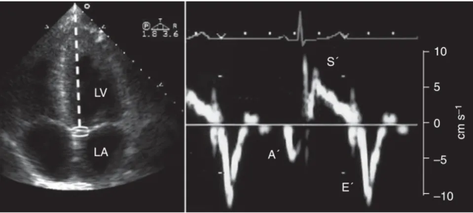 Fig 2 Recordings of pulsed-wave tissue Doppler imaging. The sample volume was placed at the septal (as indicated on left-hand side) and lateral sides