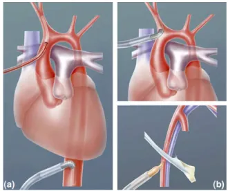 Fig. 1. Arterial cannulation technique. Arterial cannulation was established in young infants (age ,3 years) in the ascending aorta and in the descending aorta underneath the infant’s heart
