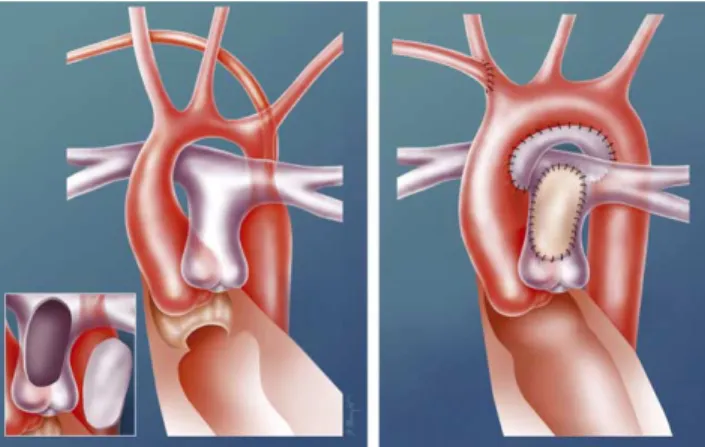 Fig. 2. Sliding plasty repair. The aortic arch is divided in the middle of the stenotic segment and an incision is performed in the bottom of the proximal part and in the top of the distal part