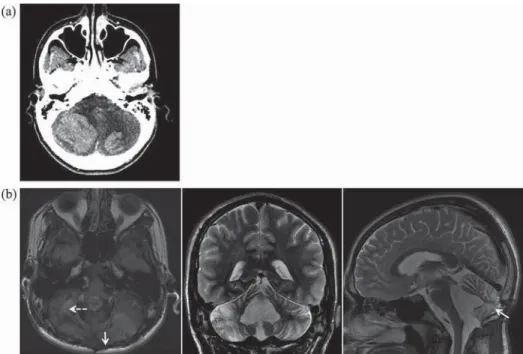 FIGURE 1 (a) Initial CT-scan showing a bilateral cerebellar hemorrhage (right is on the left side)