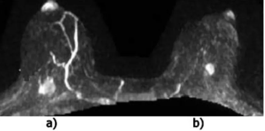 Figure 2.4 : Image IRM transversal de la poitrine du patient[20]. 