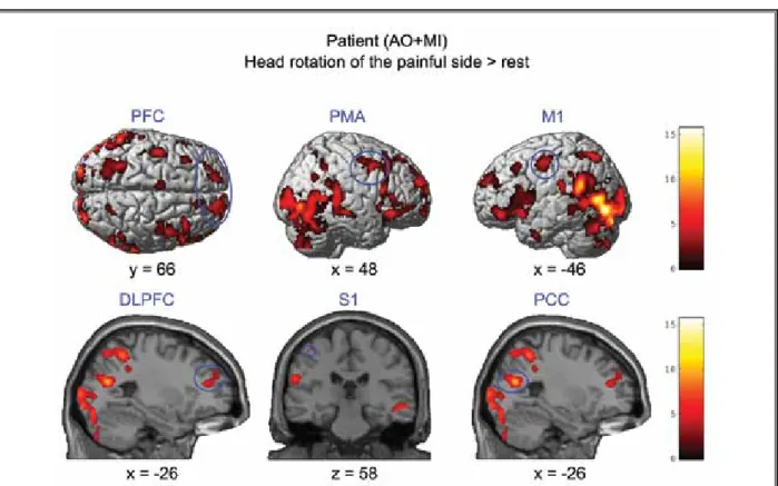 Fig. 2.  fMRI results – simple effects. Brain areas that were activated during combined motor imagery and action observation  (AO+MI) of  the pain-provoking movement to the left compared to the baseline (resting period)