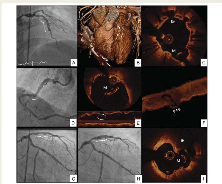Figure 2 (A– C) A case of coronary artery aneurysm at the level of the proximal left anterior descending in a 44-year-old woman who presented with ST-elevation myocardial infarction and received a 3 × 18 mm bioresorbable vascular scaffolds in the proximal 