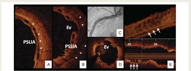 Table 2 describes the characteristics of the evaginations based on the presence of PSLIA