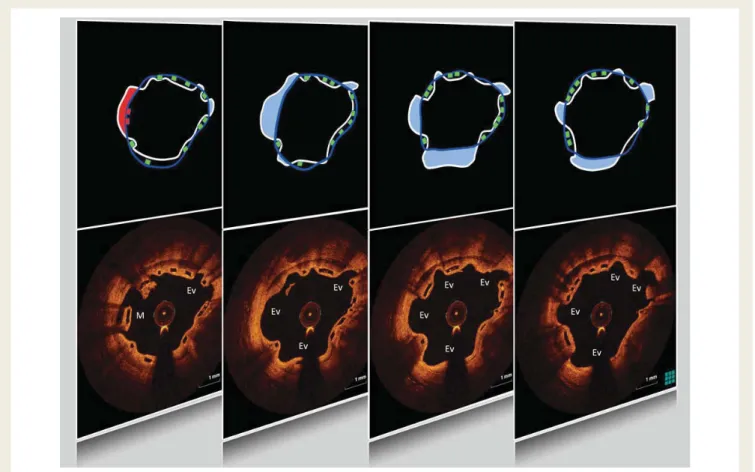 Figure 4 Sequential optical coherence tomography frames showing the continuum between evaginations and malpposition