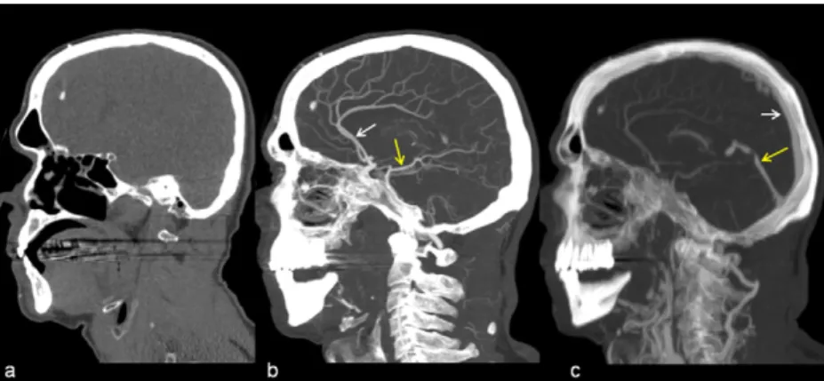 Fig. 3. Axial Maximum Intensity Projection reformation of the anterior cranial fossa reconstructed from data of the dynamic phase showing the opaciﬁed orbital vessels (yellow arrow: ophtalmic artery; pink arrow: superior ophthalmic vein)