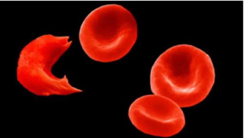 Figure 1. Un globule rouge falciforme (à gauche) et  trois globules sains. 
