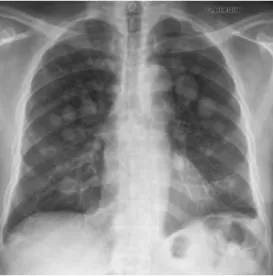 Figure 1: Le diagnostic des opacités rondes intra-parenchymateuses. (2013). Les facultés  médicales