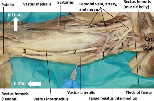 Fig. 1. Anterior overview of a left thigh showing the quadriceps femoris muscle. The rectus femoris, the  Sar-torius, and tensor fasciae latae (T) are transected and reﬂected on either side, proximally and distally