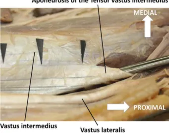 Fig. 2. The schematic drawings show the different types of the TVI and its variations with respect to  interac-tions with the VI and VL