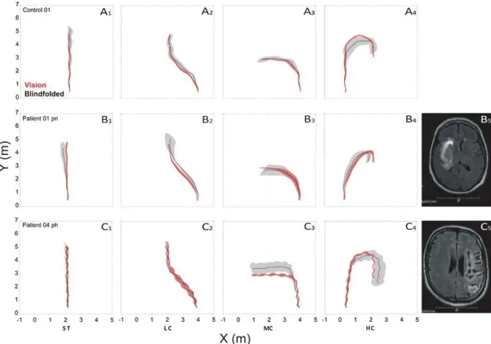 Fig. 2. Typical trajectories generated by control participants (A), non-hemiparetic (B) and hemiparetic (C) patients