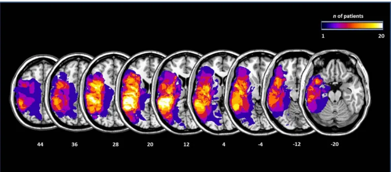 Fig 1. Lesions maps of the 20 aphasic patients, plotted on axial slices oriented according to the radiological convention