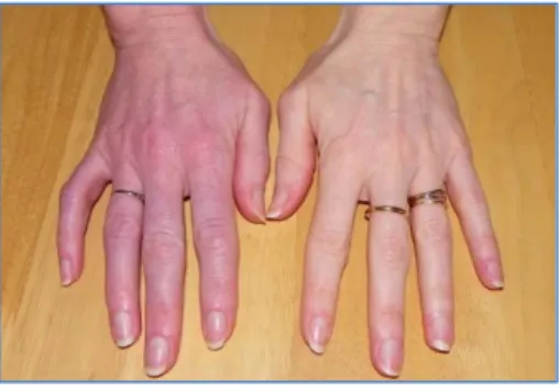 Figure 4 : Mains droite atteinte d'algodystrophie 4  
