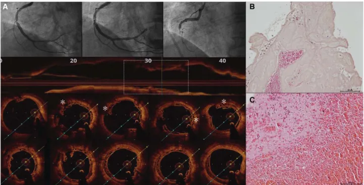 Figure 2. Very late scaffold thrombosis (ScT). A, Angiographic and optical coherence tomography (OCT) ﬁndings in a 55-year-old man  who presented with ScT 562 days after scaffold implantation