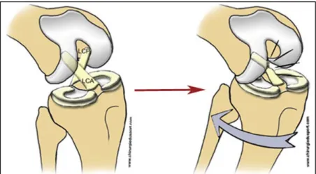 Figure 2 : Rupture du ligament croisé antérieur, source  internet : http://chirurgiedusport.com 