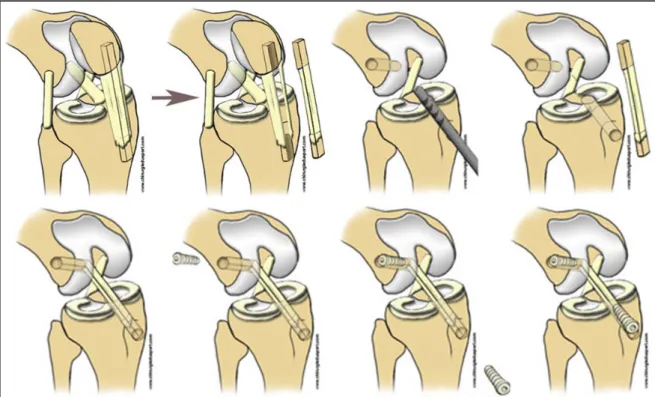 Figure 3 : Représentation schématique d’une reconstruction chirurgicale du  ligament croisé antérieur par autogreffe du tendon rotulien, source internet :  http://chirurgiedusport.com 